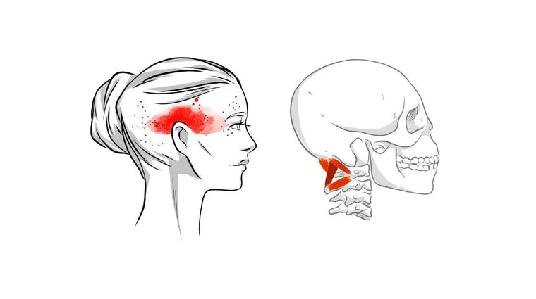 What Causes Headaches and Migraines? How Neck Tension Is Often the Missing Piece