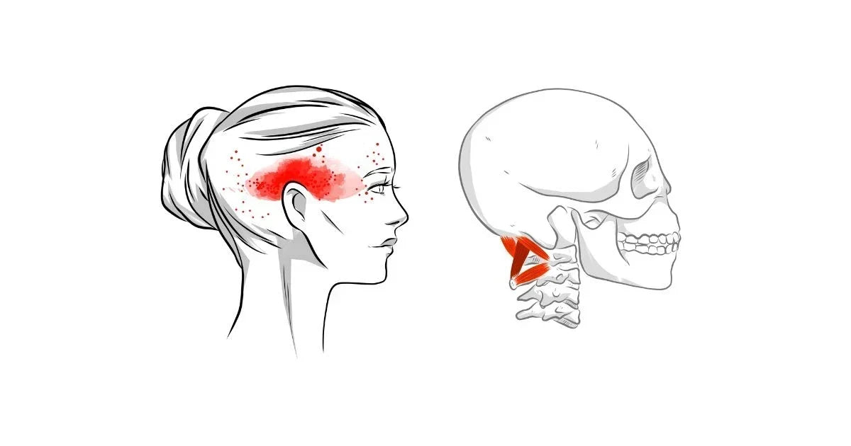What Causes Headaches and Migraines? How Neck Tension Is Often the Missing Piece